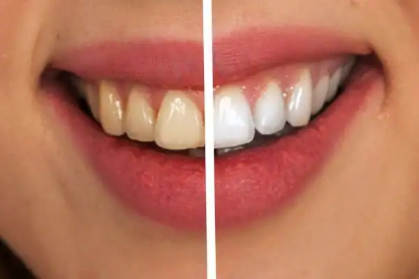 Before and after results of Blue Light Teeth Whitening Farnborough